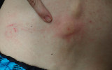 Cuts & Bruises