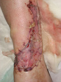 September 8th, Two Days After Surgery