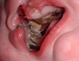 You may also follow your child's feedings with a small amount of water to rinse the mouth.