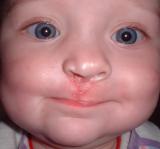 Hey All!! Well finally got to smile today without any pain. Now once this redness goes I’ll look just like all the other kids. I can go to the store and not have anymore stares at me. I even chucked my nuk nipple and got myself one of those normal nipple bottles!
