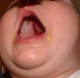The slit extends all the way to the back of my mouth. It goes directly to my nasal cavity, which results in food running out my nose.