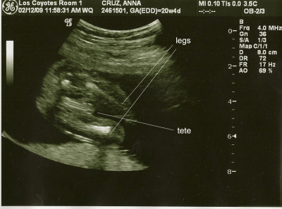 My Baby at 20 Weeks