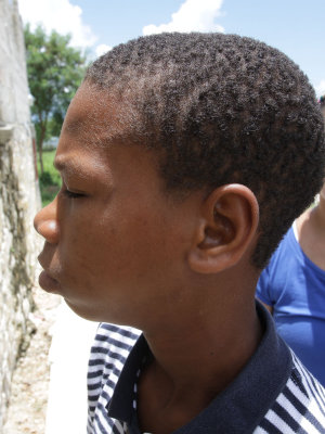 Alec a Haitian Boy In Need of Jaw Surgery ... Please Help!!!!