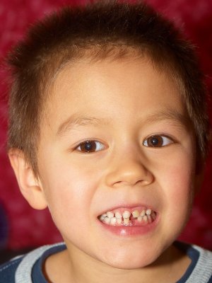 2009-02-06 Oliver lost his first tooth