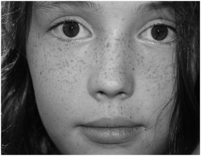 Kendra Hansen, Freckle Face