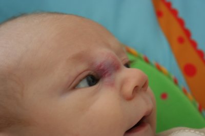 jack_hemangioma