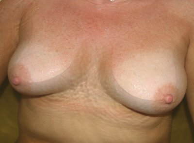 Breast Breast