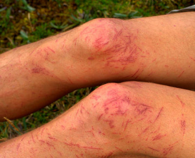 Maarten's knees following our 1st trek in Cotopaxi - the day we had to be rescued.....