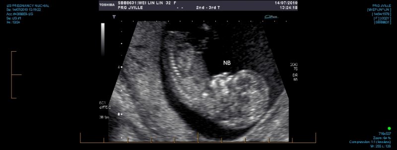US PREGNANCY NUCHAL 0012.jpg