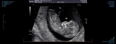 US PREGNANCY NUCHAL 0012.jpg