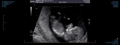 US PREGNANCY NUCHAL 0013.jpg
