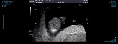 US PREGNANCY NUCHAL 0014.jpg