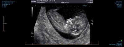 US PREGNANCY NUCHAL 0015.jpg