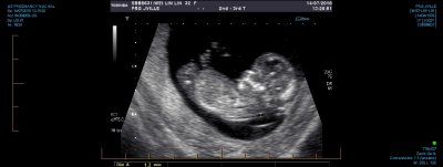 US PREGNANCY NUCHAL 0016.jpg