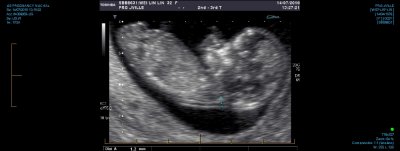 US PREGNANCY NUCHAL 0017.jpg