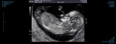 US PREGNANCY NUCHAL 0018.jpg