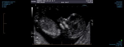 US PREGNANCY NUCHAL 0019.jpg