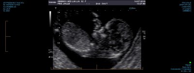 US PREGNANCY NUCHAL 0020.jpg