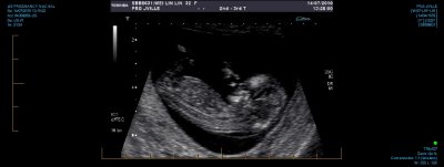 US PREGNANCY NUCHAL 0021.jpg