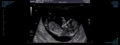 US PREGNANCY NUCHAL 0022.jpg
