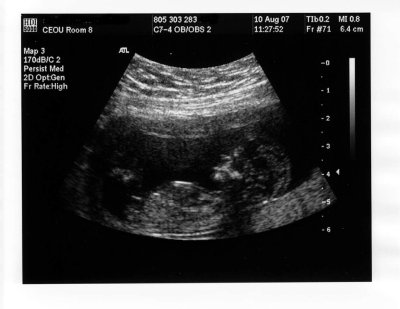 Antoine à 12 semaines et 4 jours de gestation (2007-08-10)