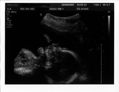 Antoine à 19 semaines de gestation 2007-09-25.jpg