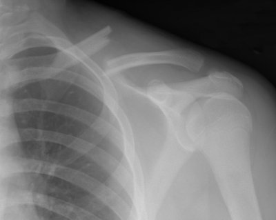 MAJOR SETBACK! I broke my left collar bone.  It will take a couple of weeks before I am able to do ANY work :-(  (stock photo)