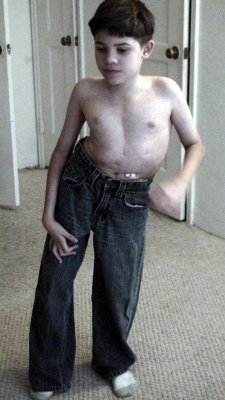 Daniel pre-surgery, 125 degree bend