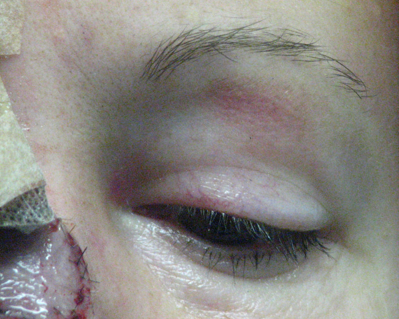 Stage One Surgery Post Op 1 Day Post Op Front Eye