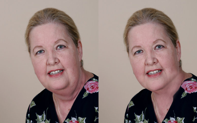 Double Chin Correction.jpg