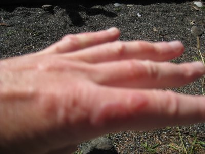 Bushwack hand inflammation