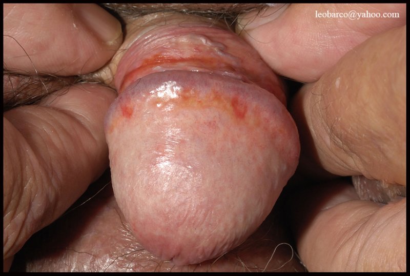 ZOONS BALANITIS.jpg