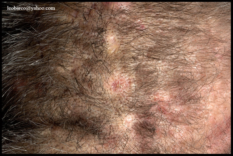 SCALP FOLLICULITIS_DISSECTING CELLULITIS OF THE SCALP_02.jpg