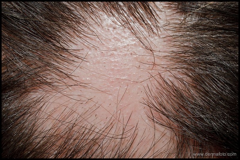 ALOPECIA AREATA_03.JPG