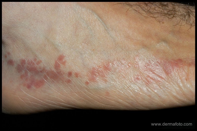 lichen_planus_01_h.JPG