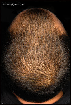 MALE ANDROGENETIC ALOPECIA_01.JPG