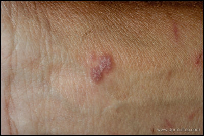 lichen_planus_02_h.JPG