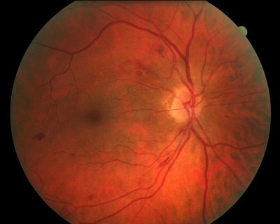 Hypertensive Retinopathy