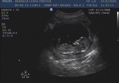 12 weeks and 4 days