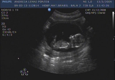 12 weeks and 4 days