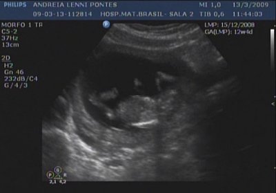 12 weeks and 4 days