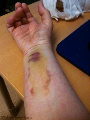 21/11 Nice bruise ;o)