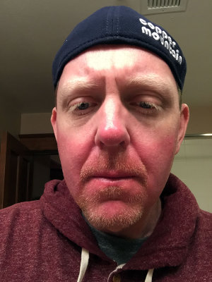 sunburntCO.jpg