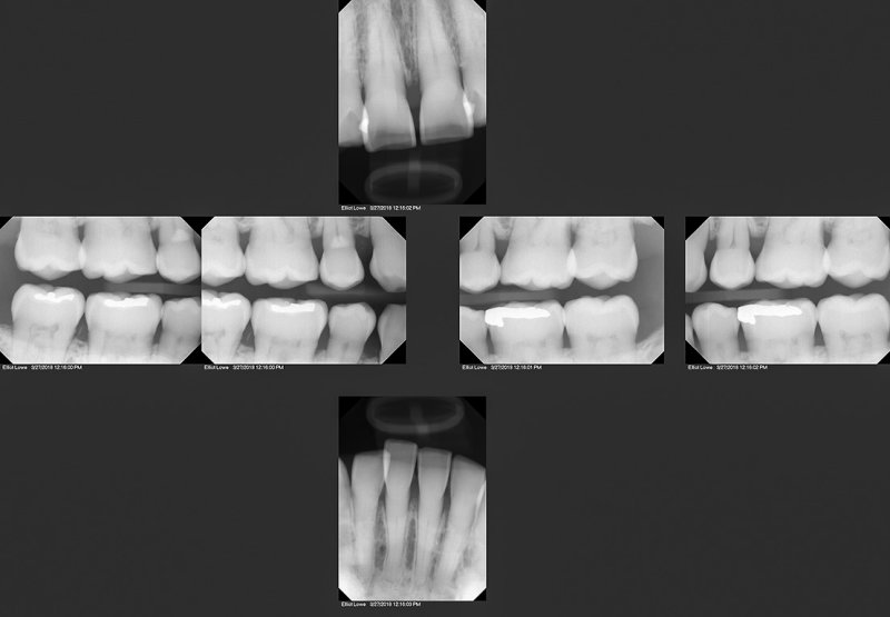 3/27/2018  My dental X-rays