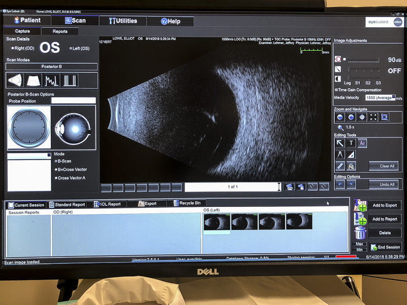 6/14/2018  Eye ultrasound