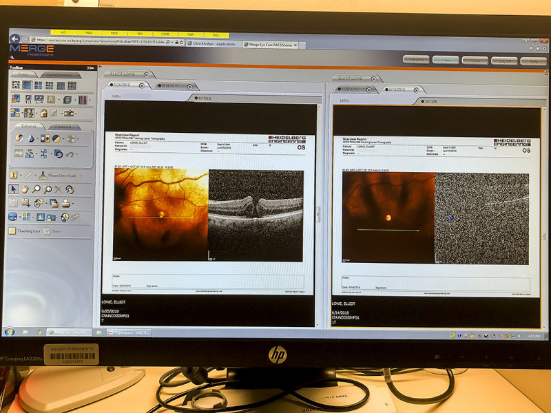 6/25/2018  Optical coherence tomography