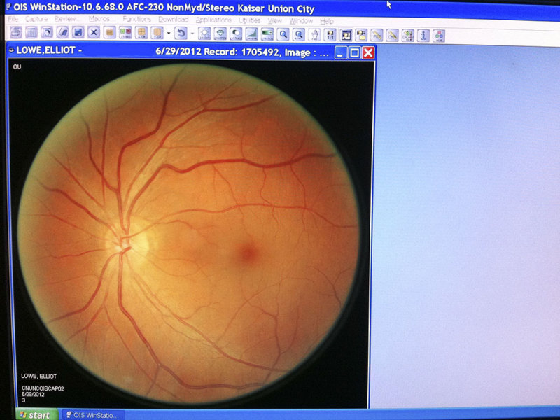 Diabetic retinal screen