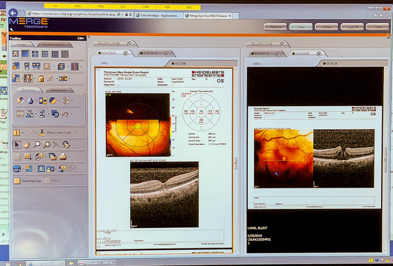 8/24/2018  My macular hole is closed