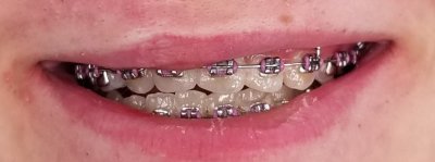 The Encore...my Braces get removed 12/8/2017
