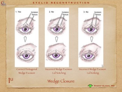 Eyelid Reconstruction.011.jpeg